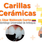 Carillas ceramicas