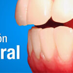 Oclusion bilateral