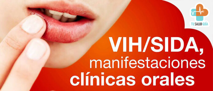 VIH-SIDA Manifestaciones clinicas bucales